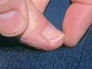Трещины на пальцах возле ногтей: причины, лечение